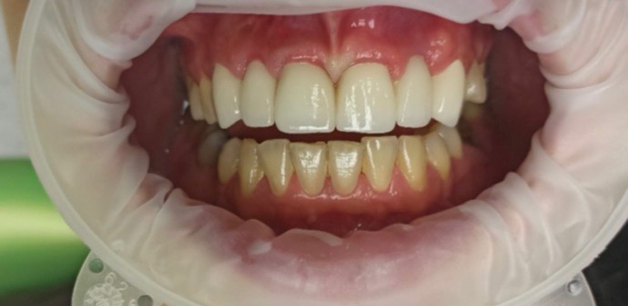 Zubné mostiky farba A2