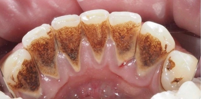 Dentálna hygiena s pieskovaním